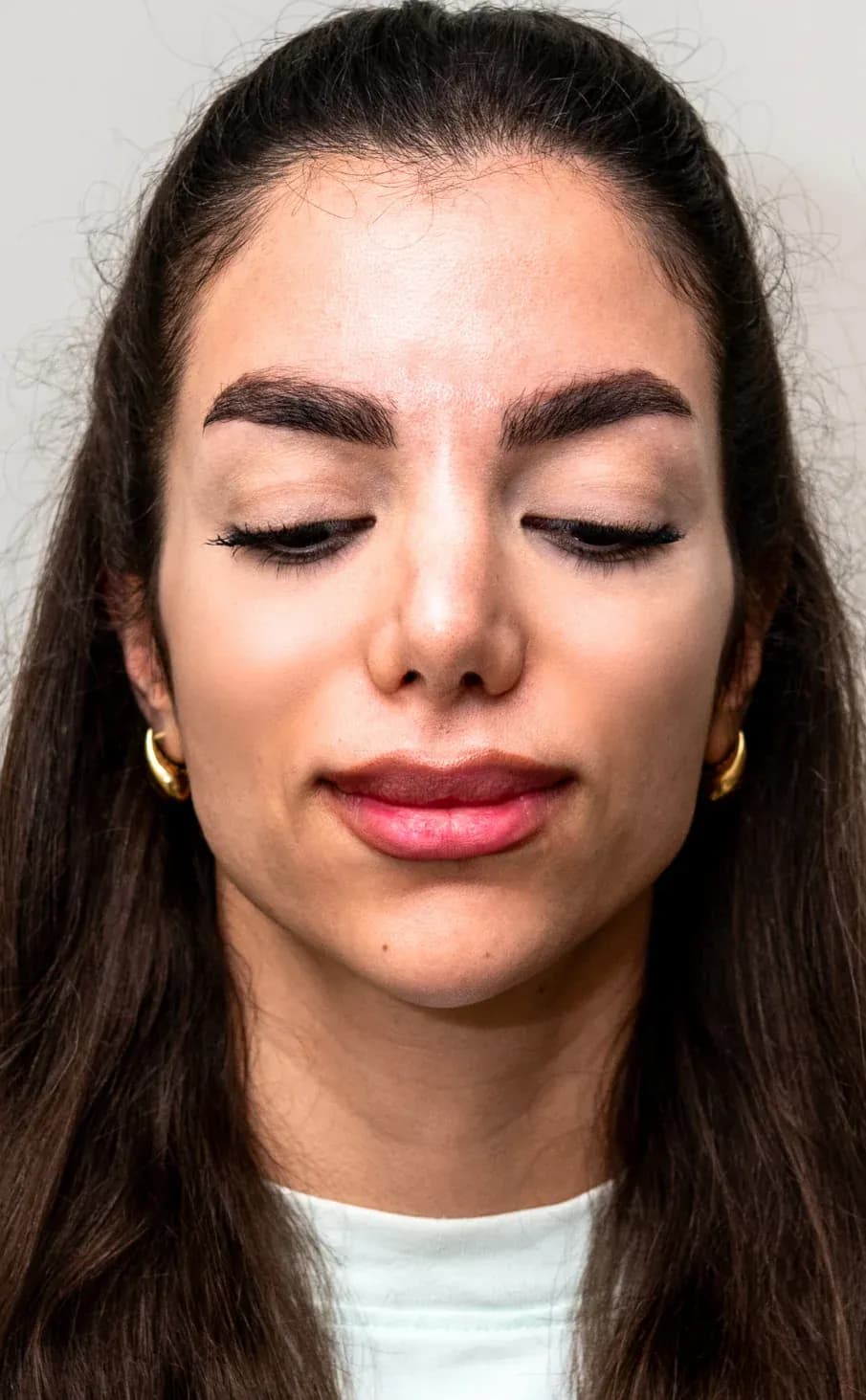 نتيجة فيلر منتصف الوجه المميزة بعد العلاج