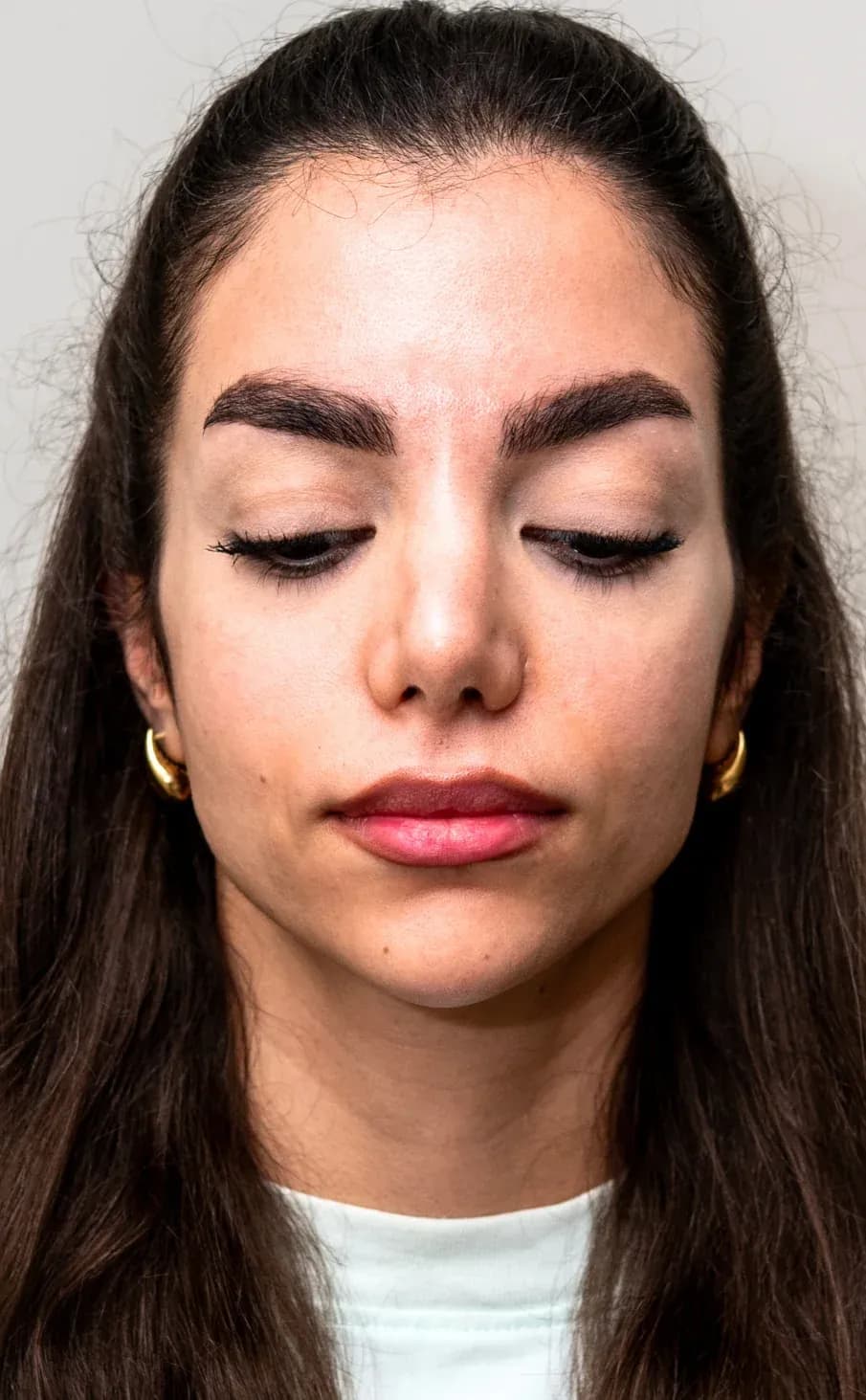 نتيجة فيلر منتصف الوجه المميزة قبل العلاج