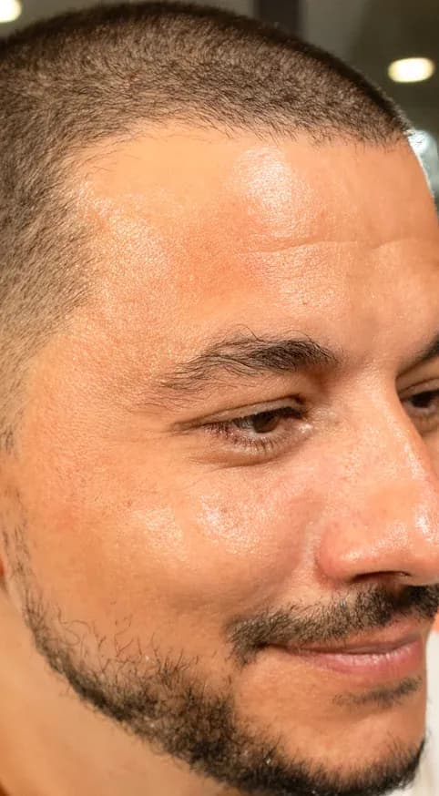 شد منطقة اللحية بفوتونا 7D بعد العلاج