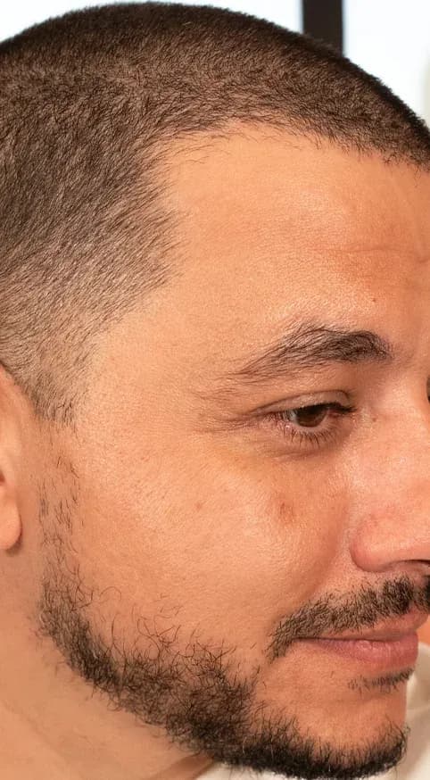 شد منطقة اللحية بفوتونا 7D قبل العلاج