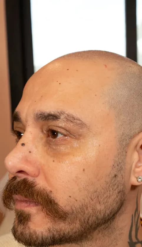 شد البروفايل بفوتونا 7D قبل العلاج