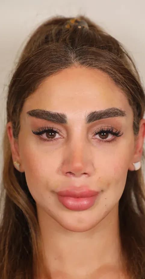 نتيجة الليفت الكوري ثلاثي الأبعاد بعد العلاج