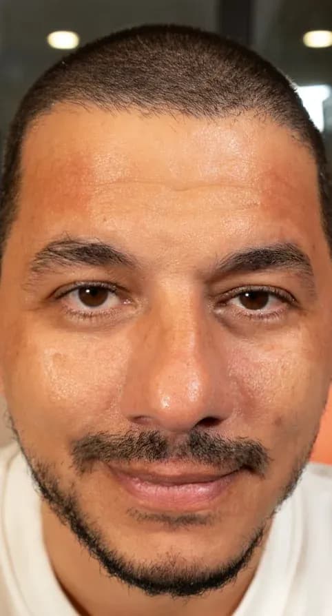 نتيجة تناغم الوجه بفوتونا 7D بعد العلاج