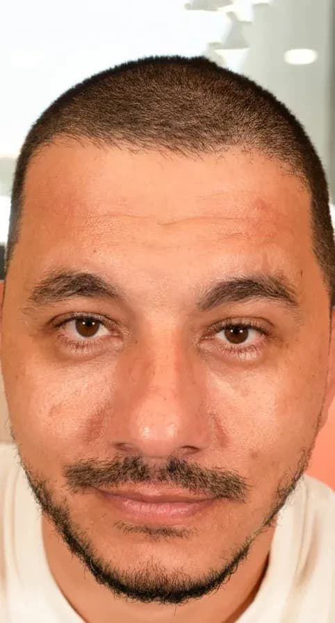 نتيجة تناغم الوجه بفوتونا 7D قبل العلاج