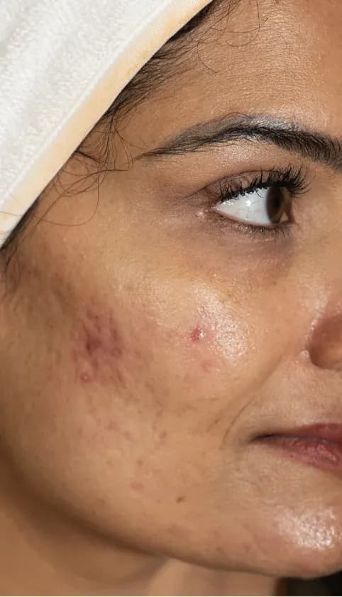 تحسين ملمس الندبات قبل العلاج