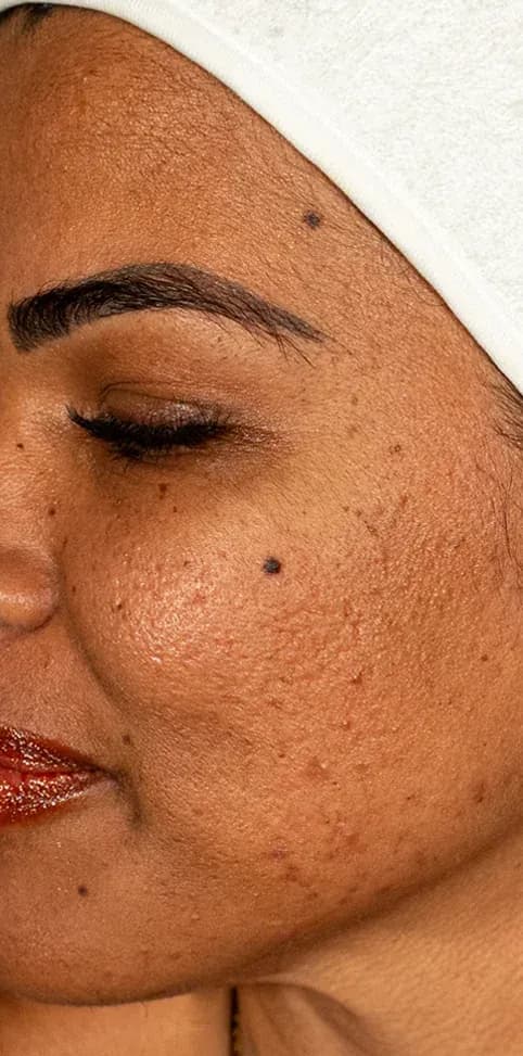 نتيجة علاج الندبات وملمس البشرة قبل العلاج