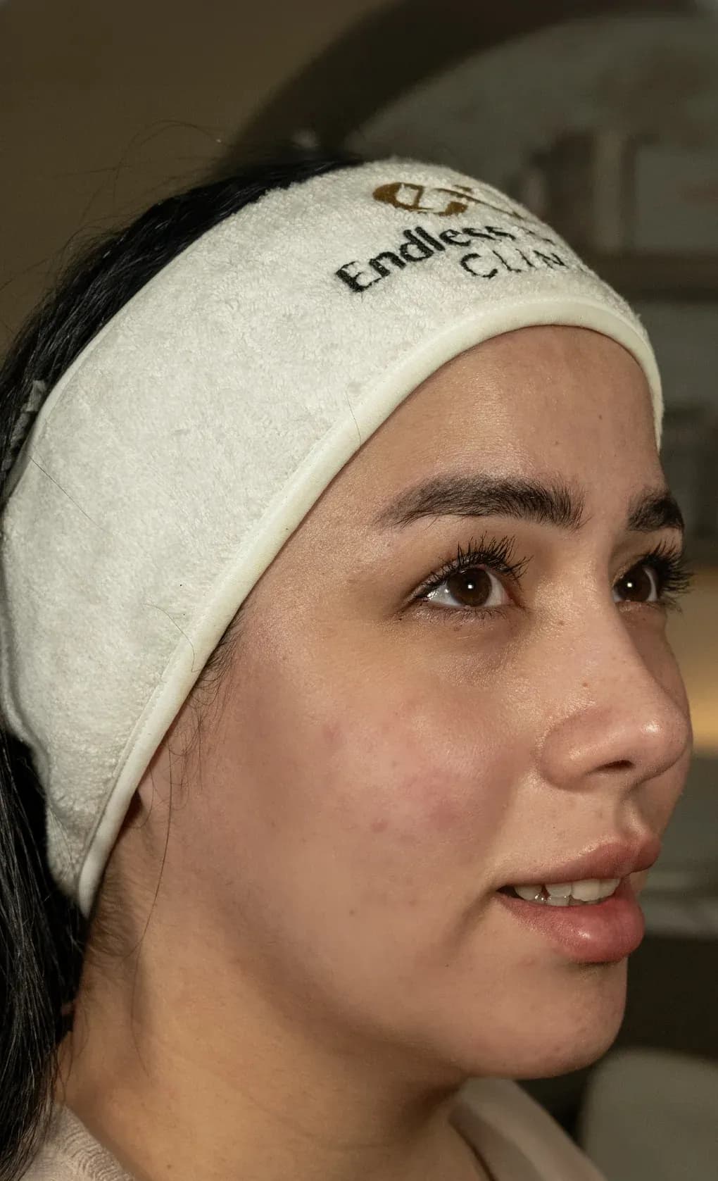 نتيجة شد الوجه بفوتونا بعد العلاج