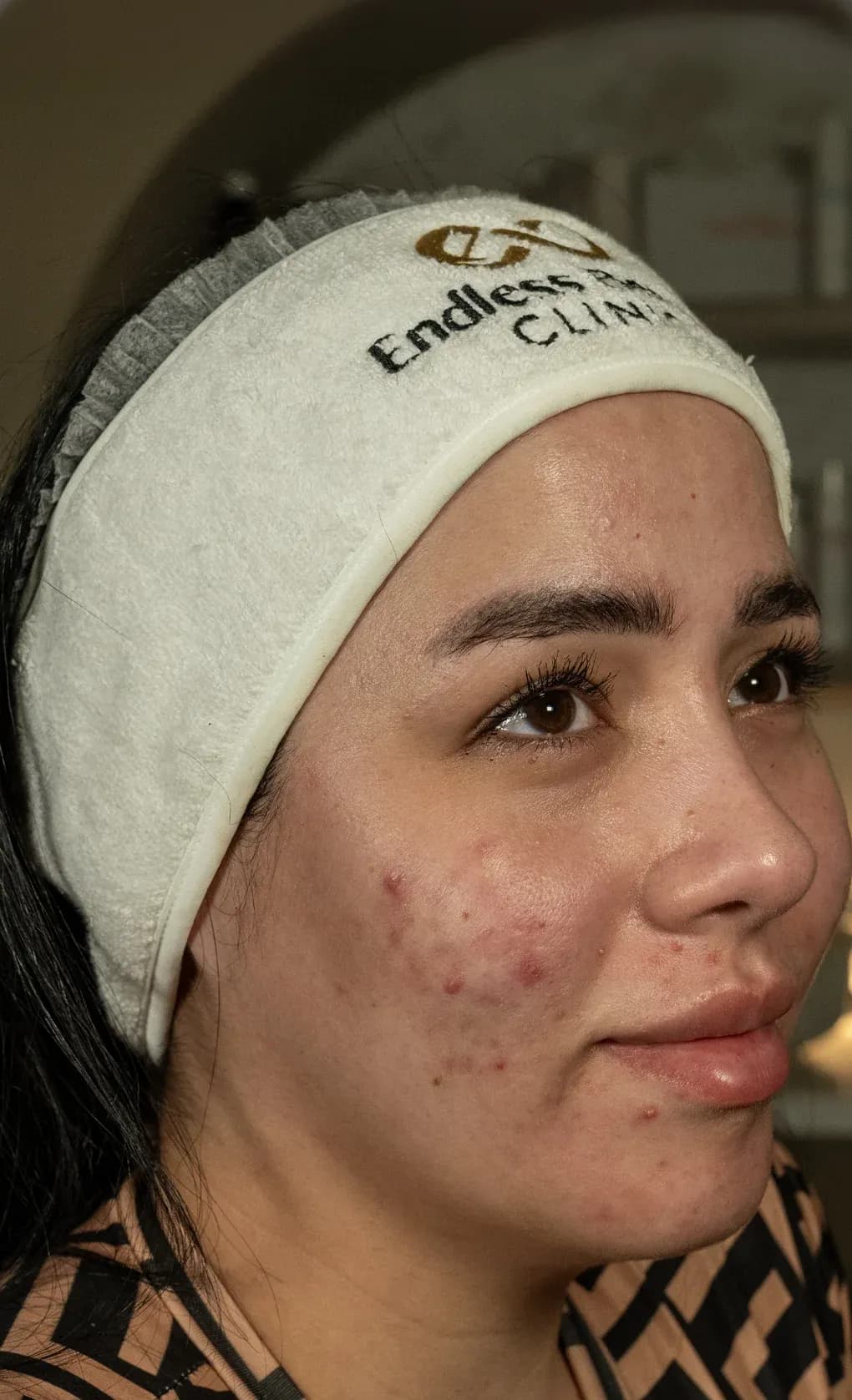 نتيجة شد الوجه بفوتونا قبل العلاج