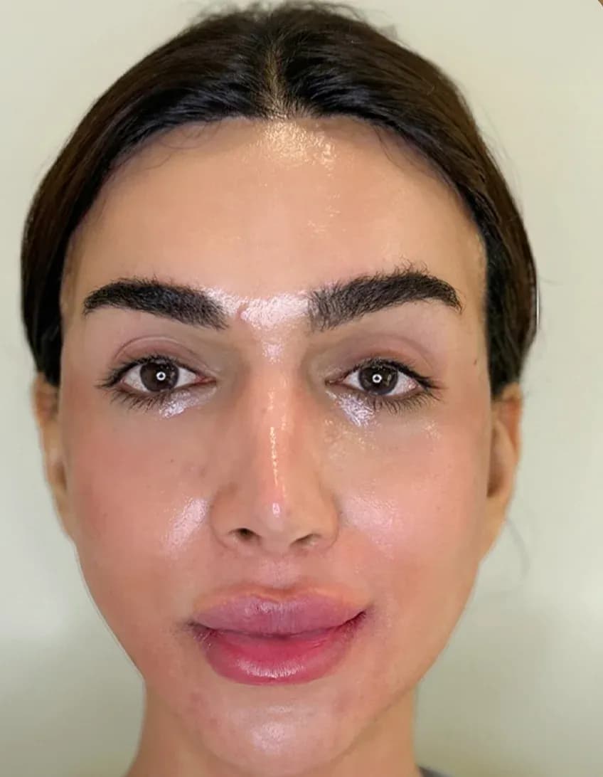 نتيجة أمامية لليفت الكوري 3D بعد العلاج