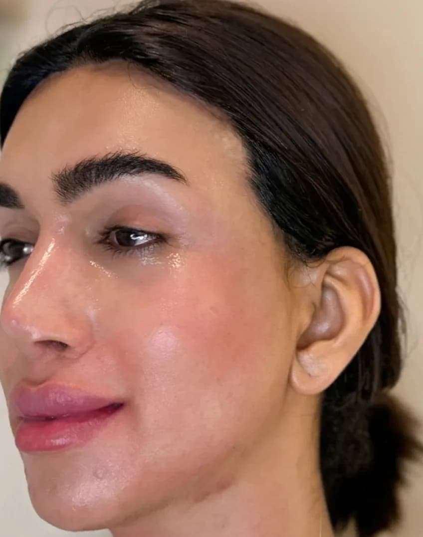 نتيجة بروفايل الليفت الكوري 3D بعد العلاج