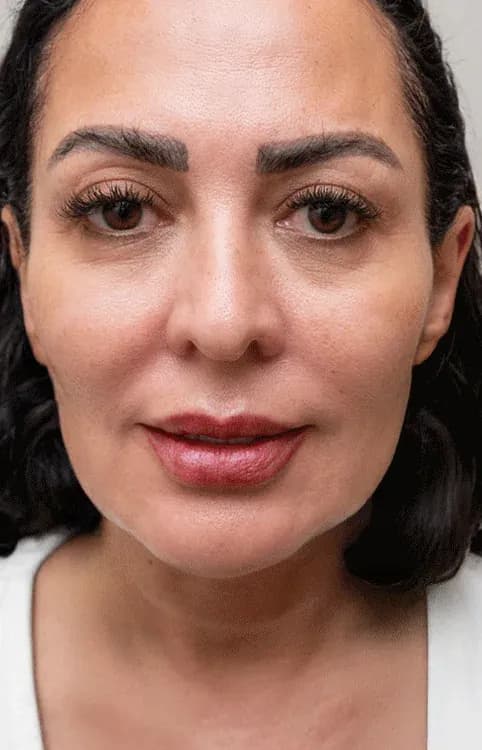 نتيجة جودة البشرة ببروفايلو بعد العلاج