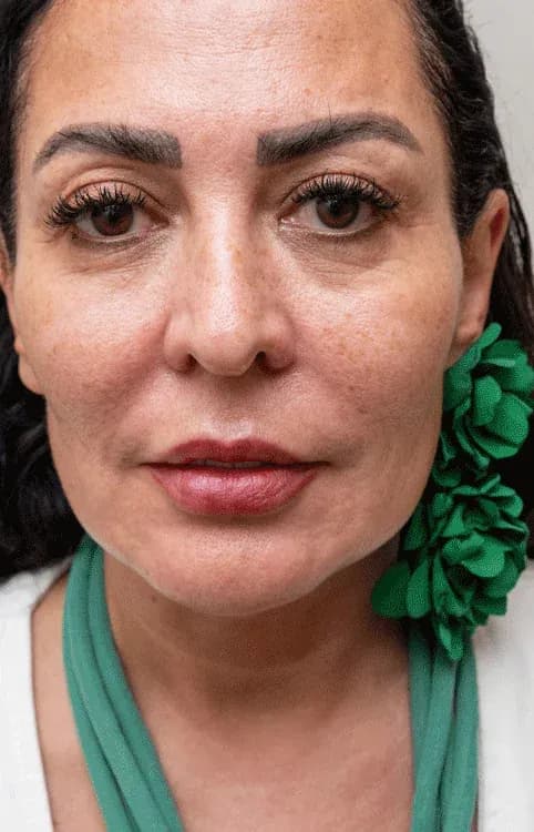 نتيجة جودة البشرة ببروفايلو قبل العلاج