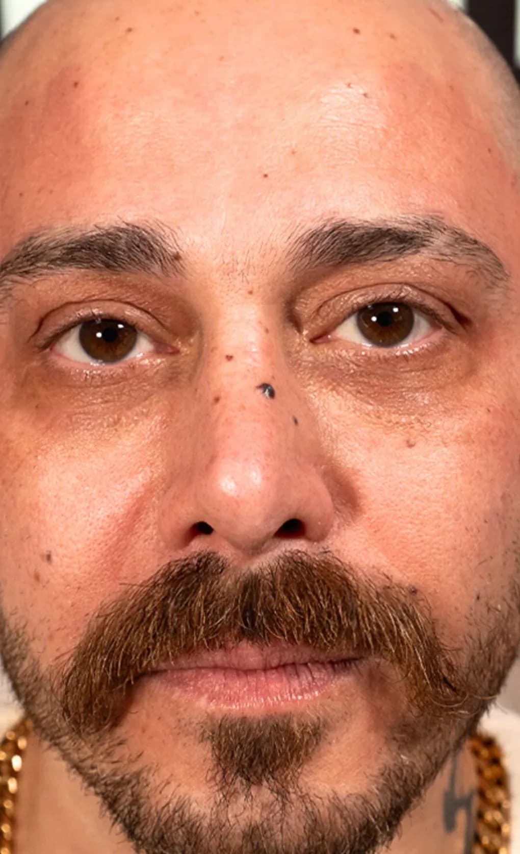 نتيجة فيشل الشد بفوتونا بعد العلاج