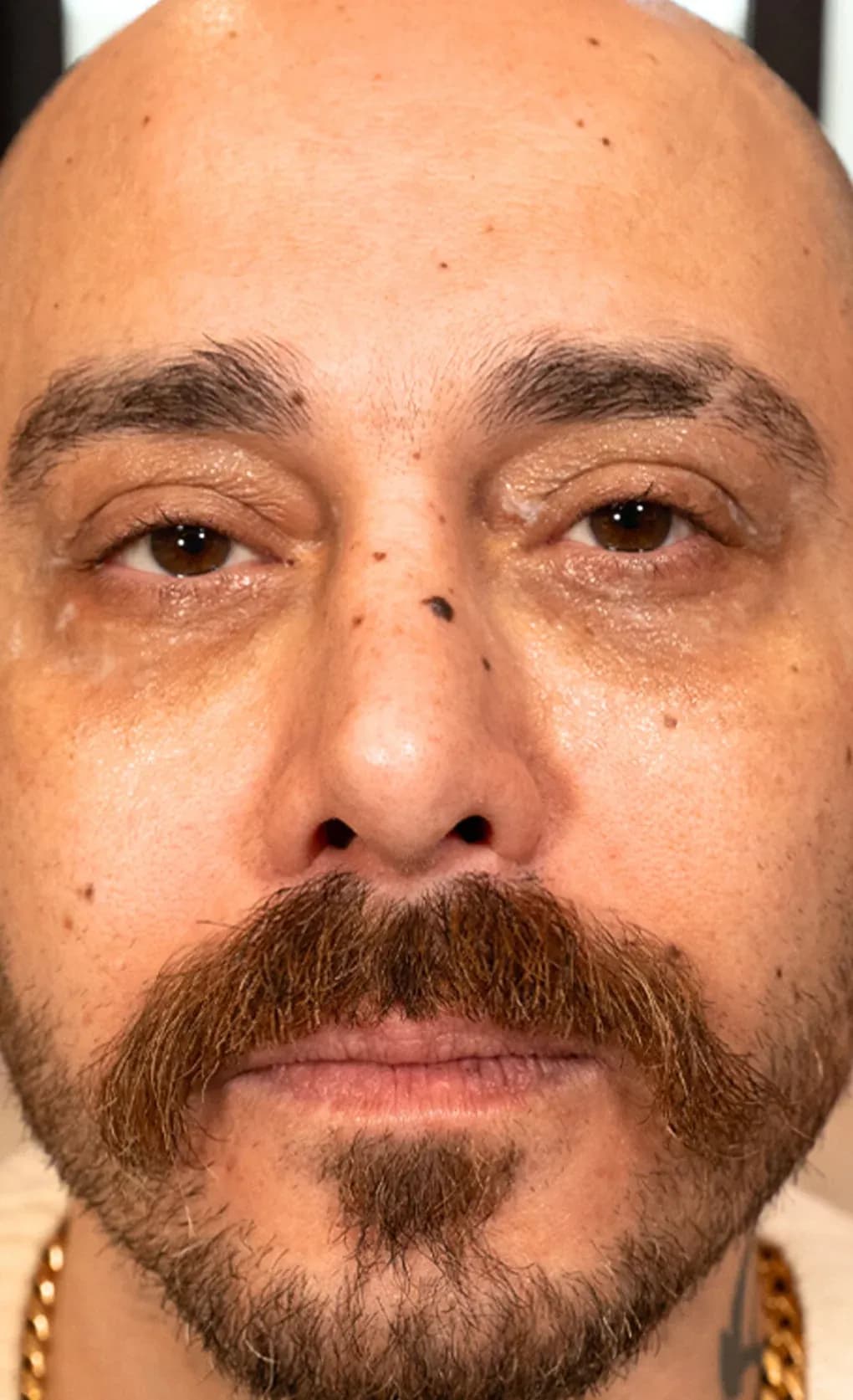 نتيجة فيشل الشد بفوتونا قبل العلاج