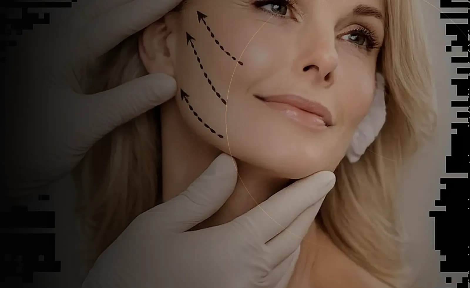 بالابر نخ PDO در دبی at Endless Beauty Clinic Dubai