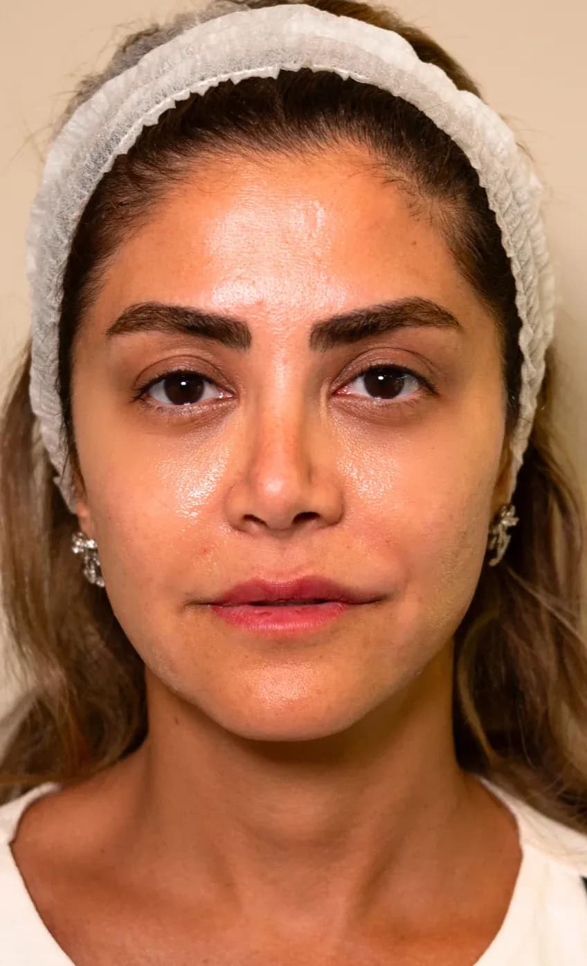 Signature Skin Booster Result after treatment