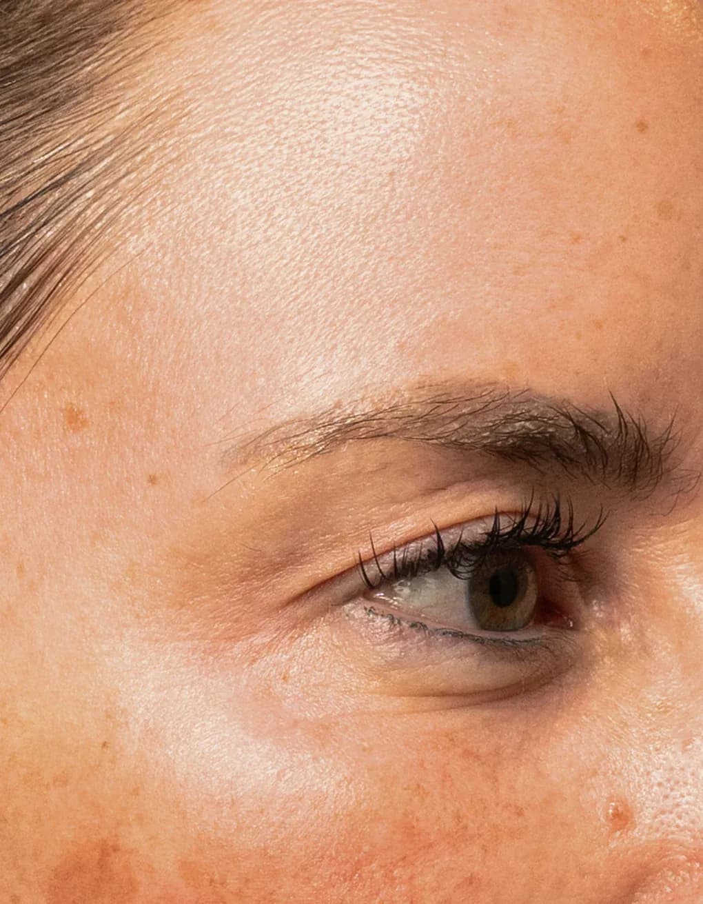 Fotona Eye Wrinkle Rejuvenation after treatment