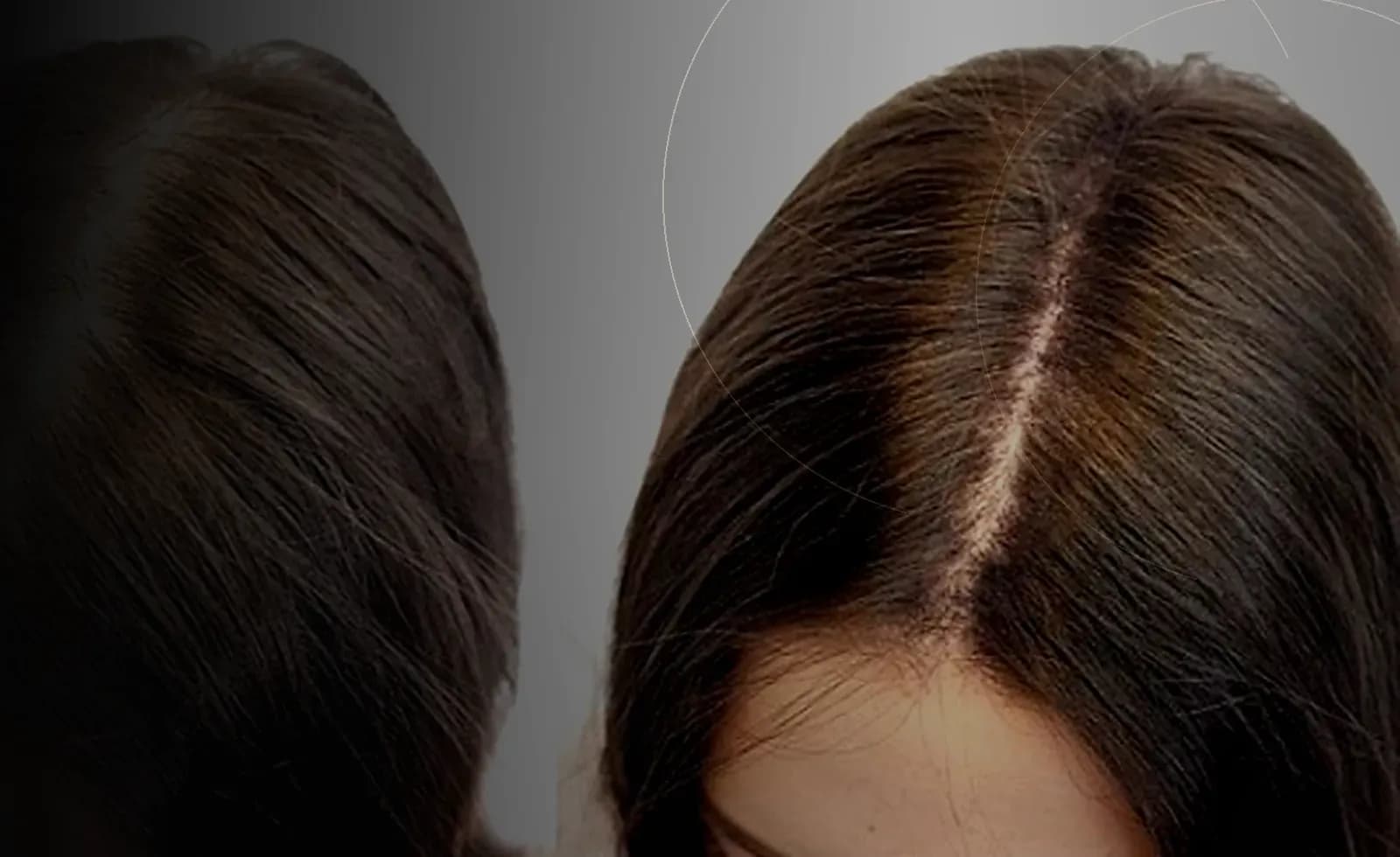 جوانسازی پوست سر و تقویت مو در دبی at Endless Beauty Clinic Dubai