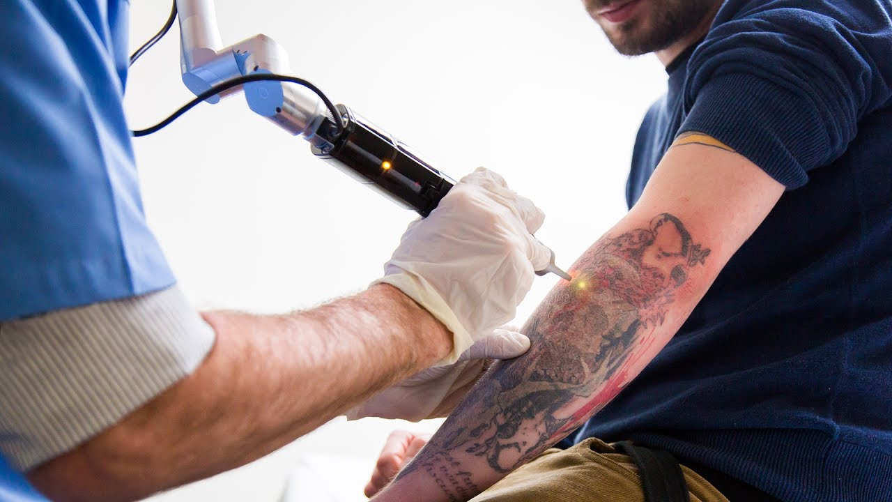 Laser Tatto Removal Cost