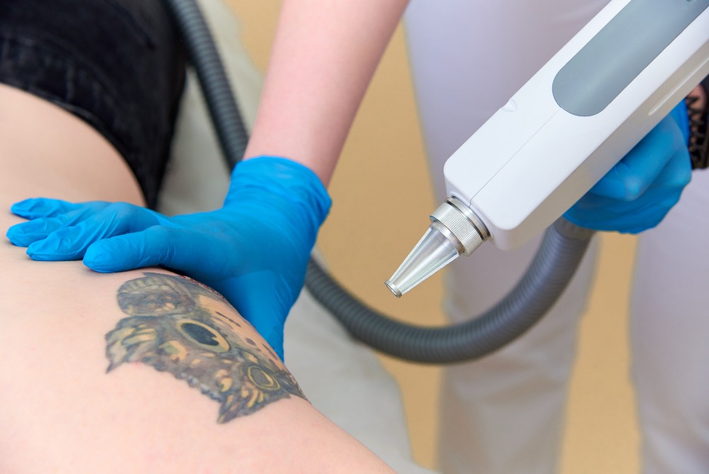Laser Tattoo Removal Near Me