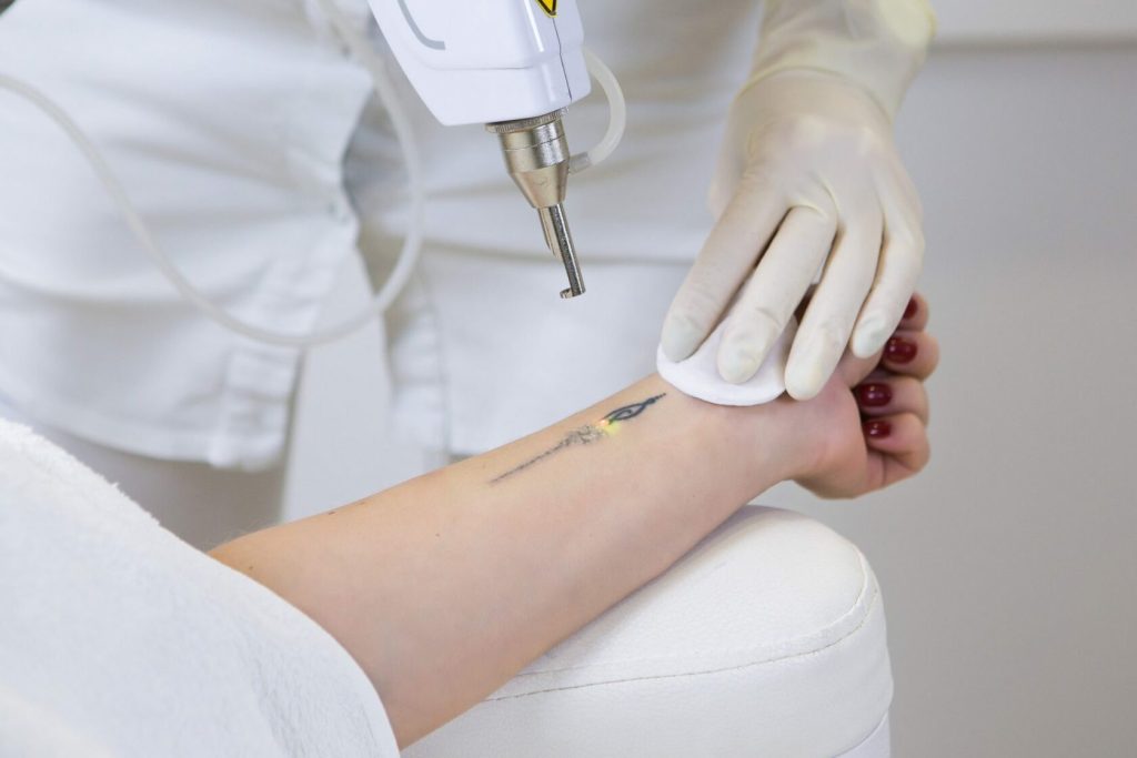 Laser Tatoo Removal