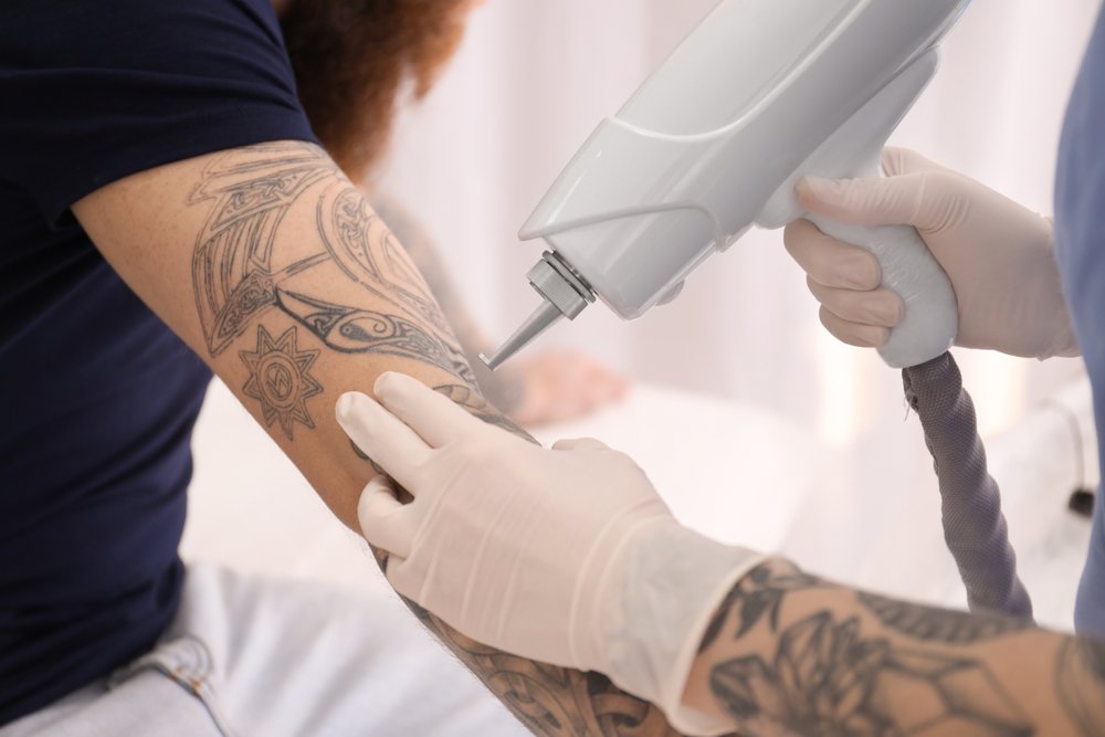 Laser Tatoo Removal Near Me