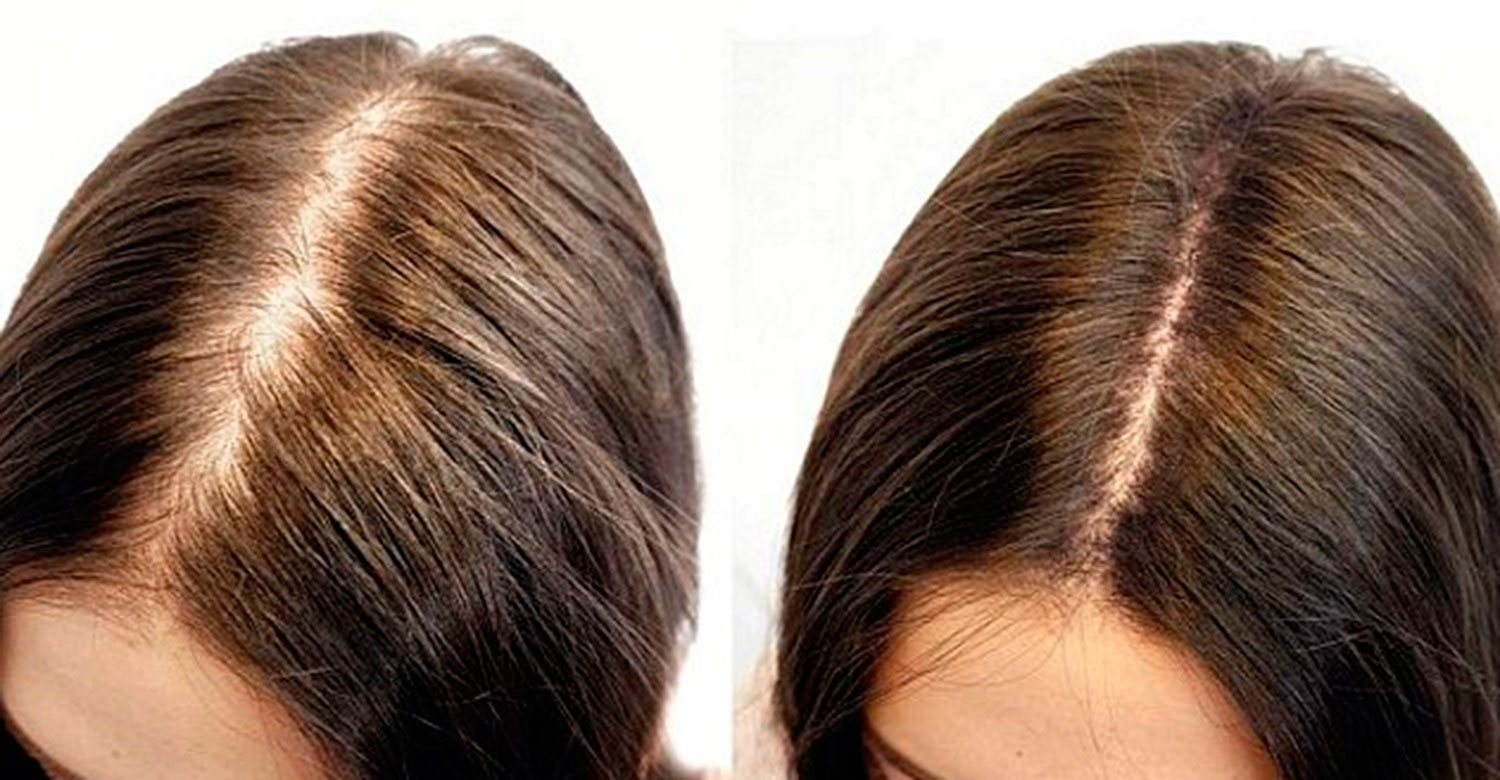 Blog 30 hair filler Dubai