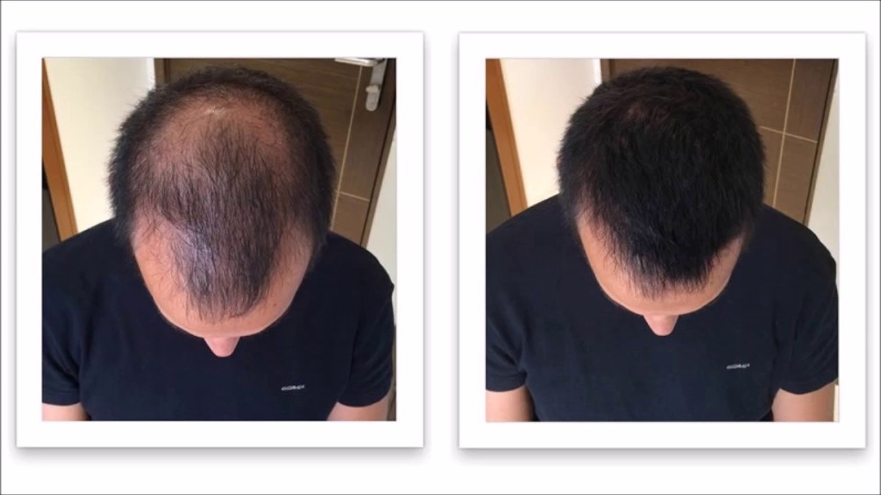 hair regrowth