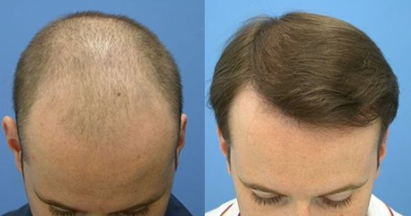 Alopecia Treatment in Dubai